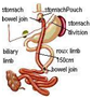 RNY-gastric bypass